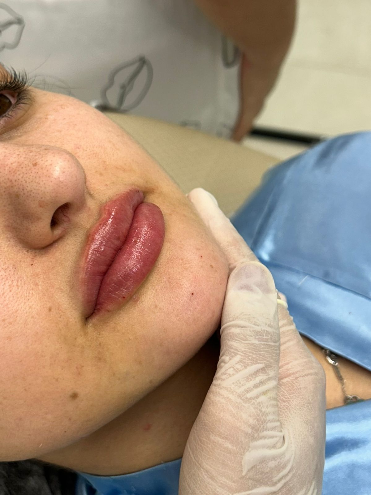 Resultado de preenchimento labial — volume natural e harmonioso